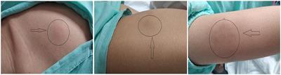 Case Report: Chronic Active Epstein–Barr Virus Infection With Subcutaneous Nodules and Systemic Damage